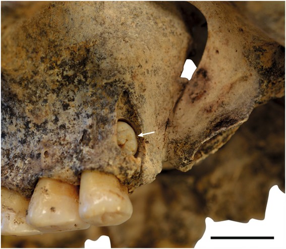 Molar supernumerario retenido – distomolar – en el maxilar izquierdo de la hembra H1 (J. Vachová)