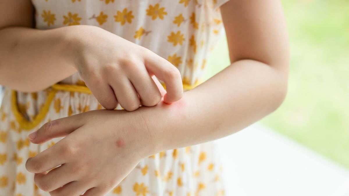 Picaduras de mosquitos