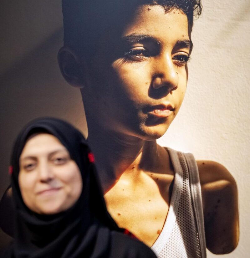 Un niño amputado